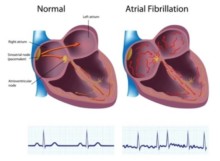 Atrial Fibrillation (AFib) Awareness - What to Know About AFib - Tri ...